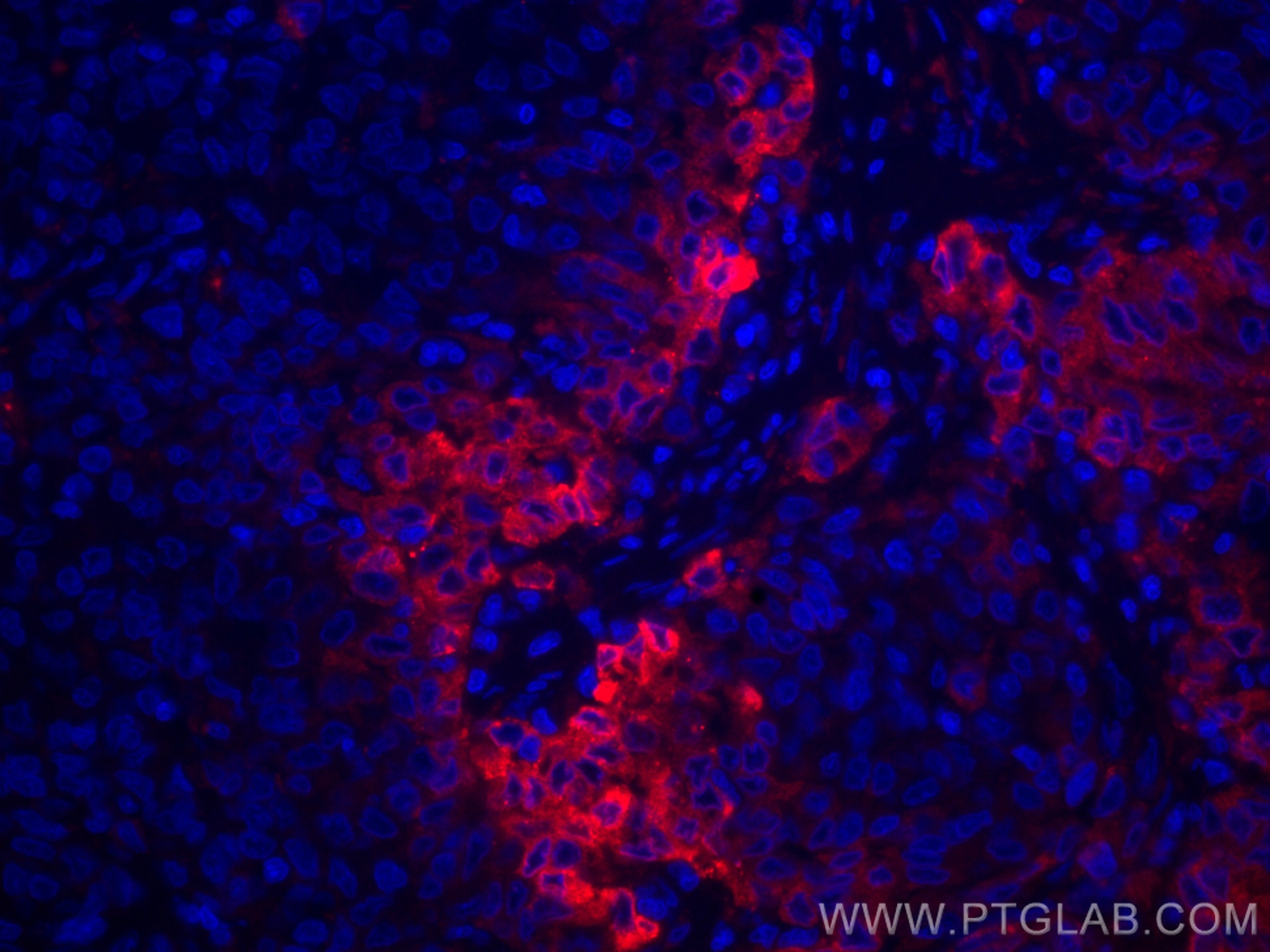 IF Staining of human stomach cancer using CL594-67416