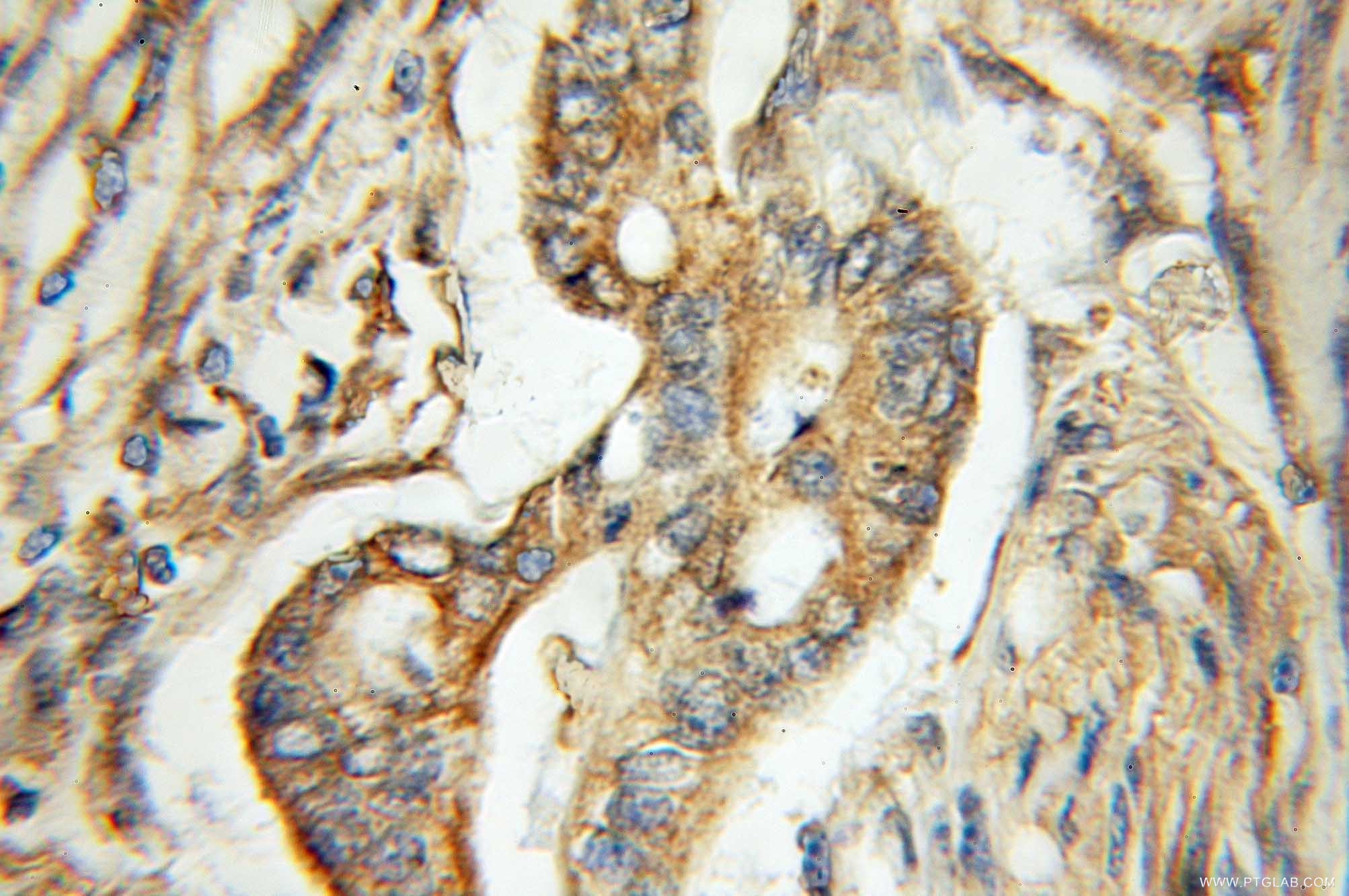 Immunohistochemistry (IHC) staining of human pancreas cancer tissue using ERO1LB Polyclonal antibody (11261-2-AP)