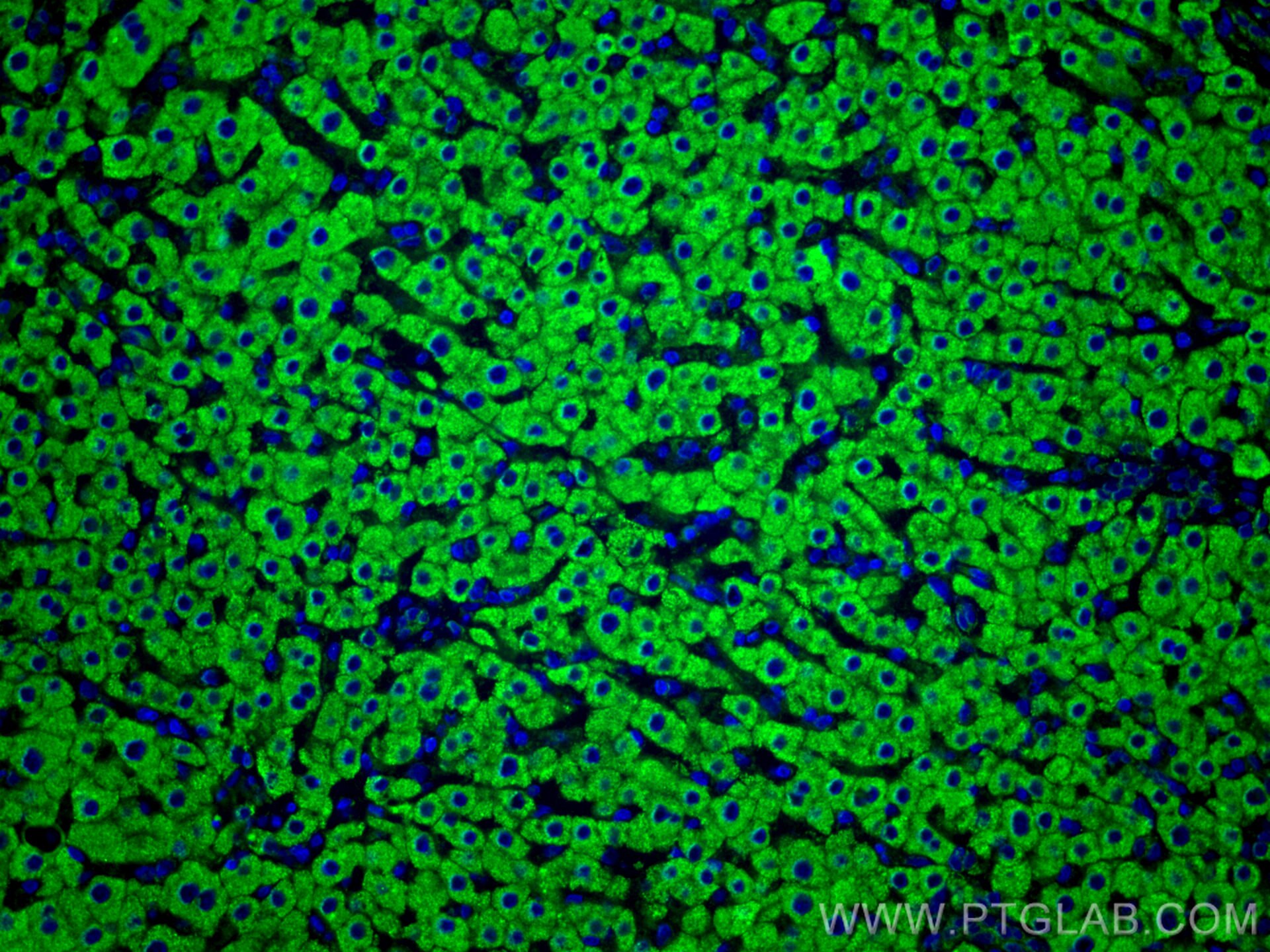 Immunofluorescence (IF) / fluorescent staining of human liver cancer tissue using ERP29 Polyclonal antibody (24344-1-AP)