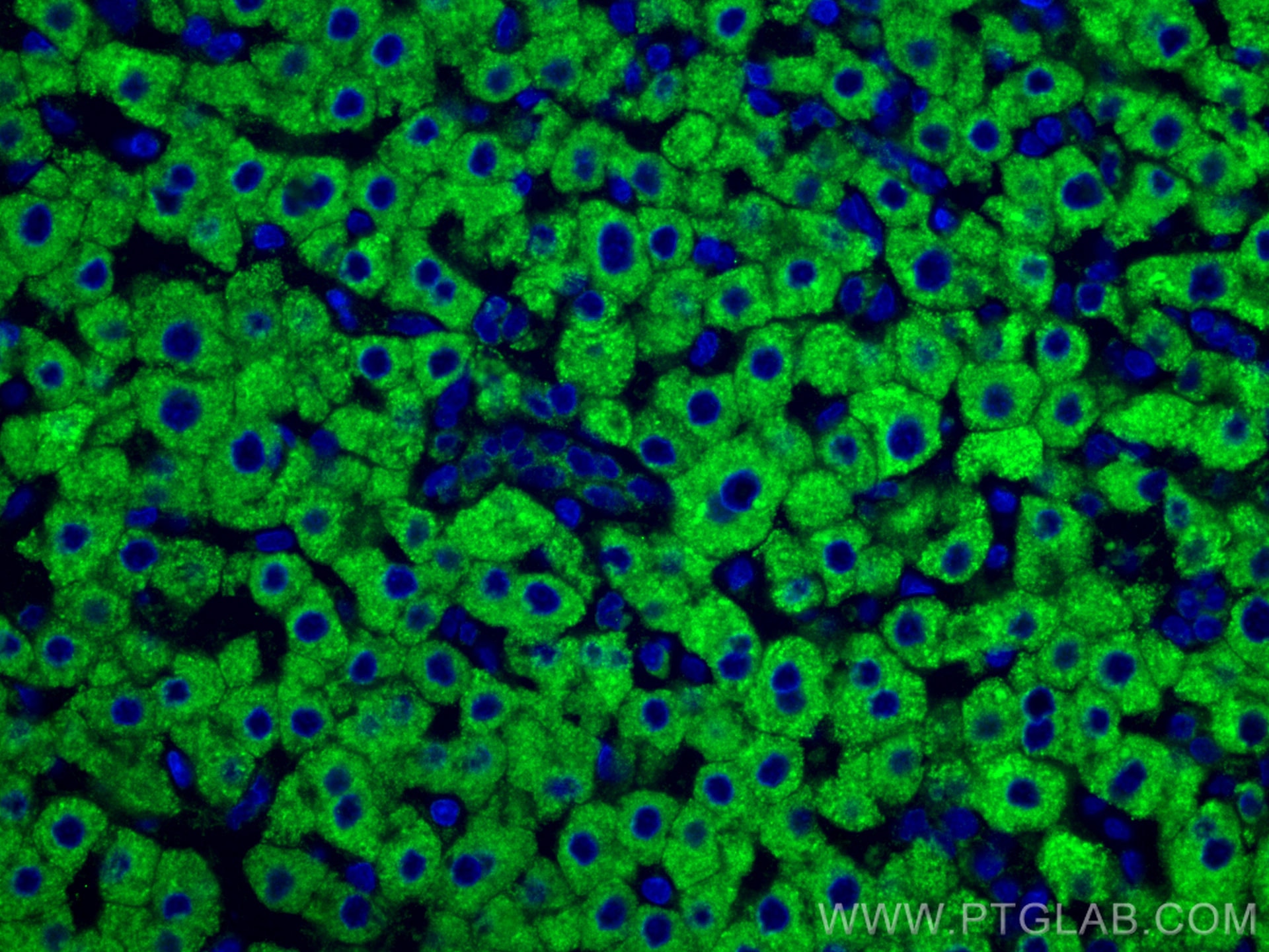 Immunofluorescence (IF) / fluorescent staining of human liver cancer tissue using ERP29 Polyclonal antibody (24344-1-AP)