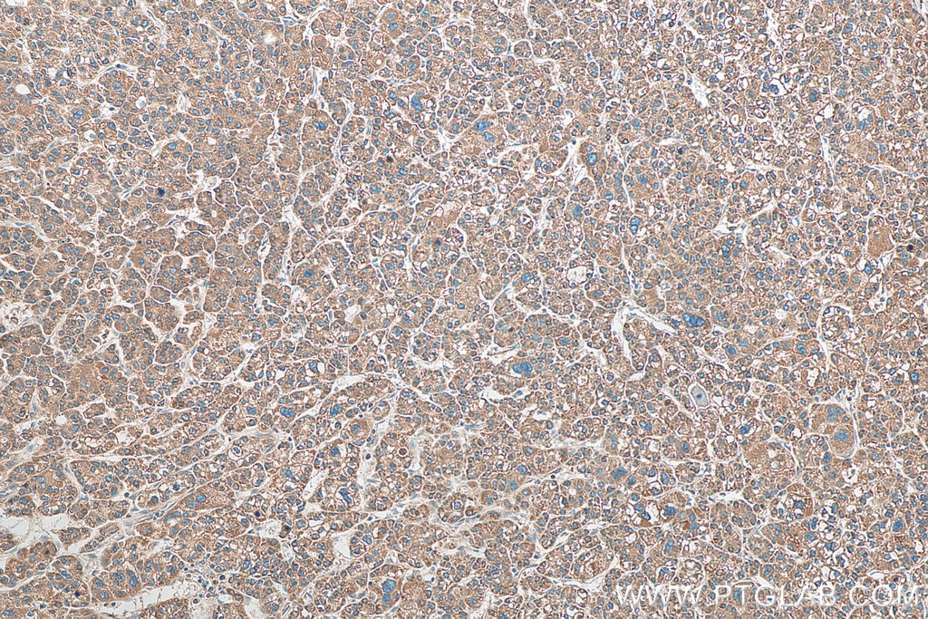 Immunohistochemistry (IHC) staining of human liver cancer tissue using ERP29 Polyclonal antibody (24344-1-AP)