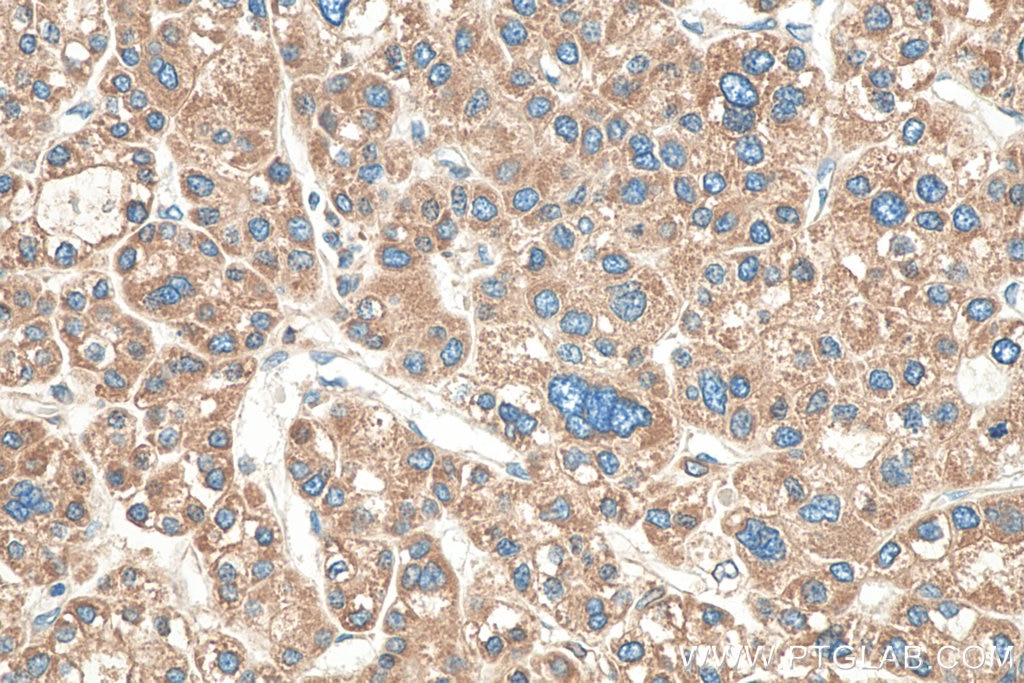 Immunohistochemistry (IHC) staining of human liver cancer tissue using ERP29 Polyclonal antibody (24344-1-AP)