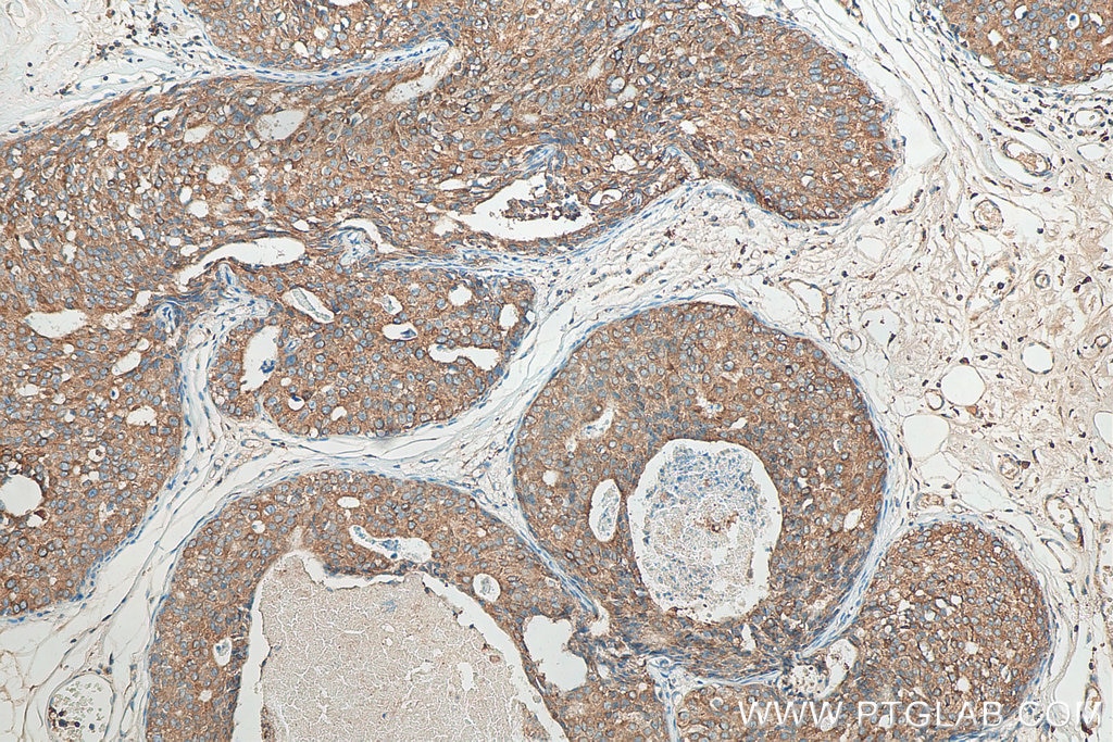 Immunohistochemistry (IHC) staining of human breast cancer tissue using ERP29 Polyclonal antibody (24344-1-AP)