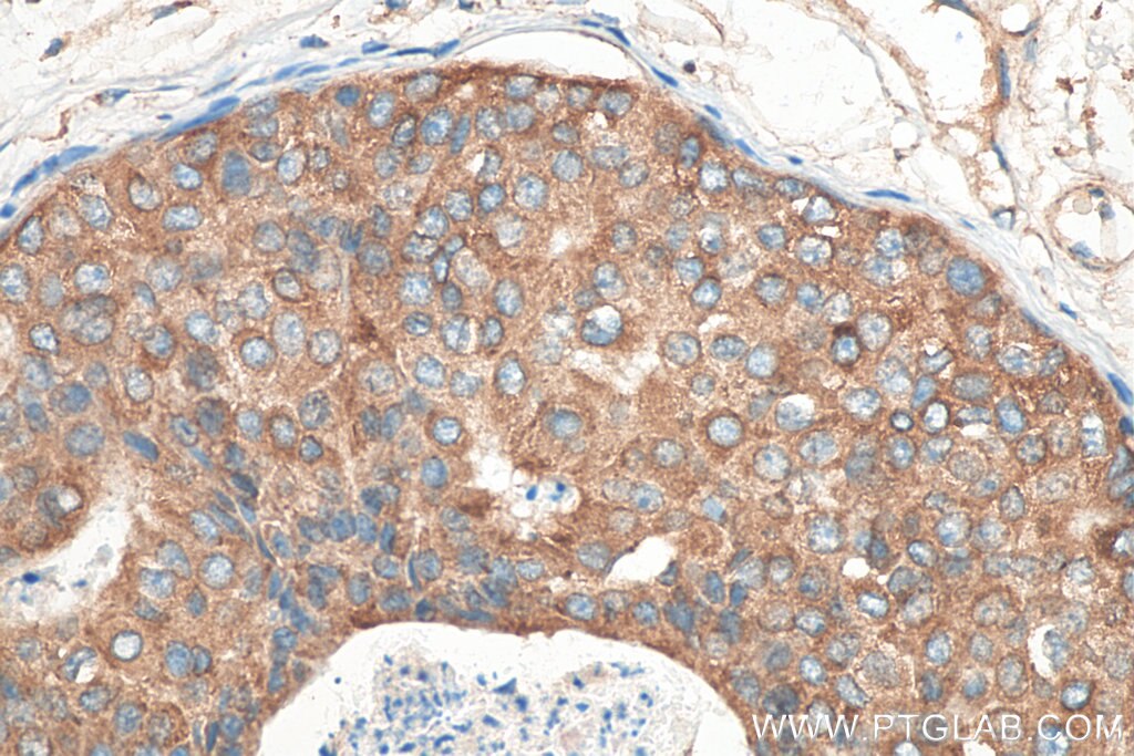 IHC staining of human breast cancer using 24344-1-AP