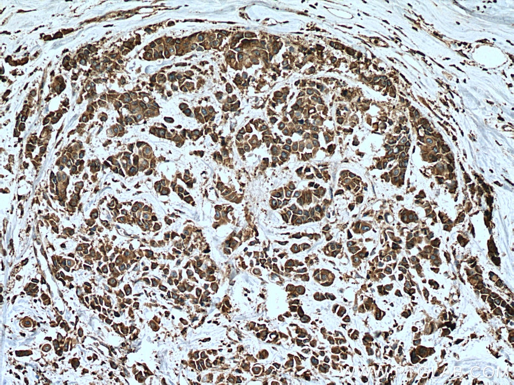 Immunohistochemistry (IHC) staining of human breast cancer tissue using TXNDC4 Polyclonal antibody (16016-1-AP)