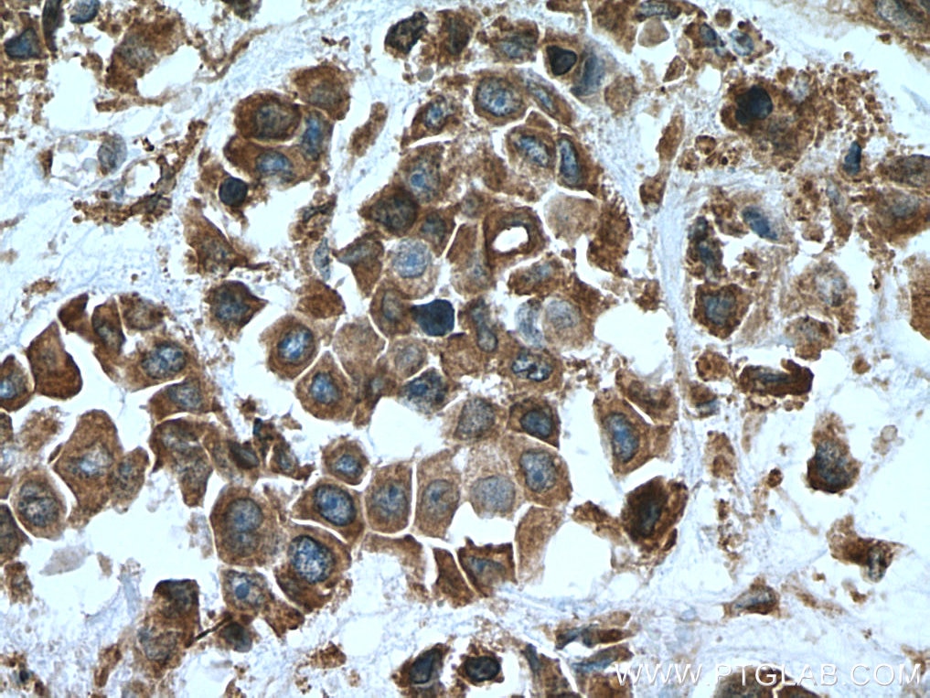 Immunohistochemistry (IHC) staining of human breast cancer tissue using TXNDC4 Polyclonal antibody (16016-1-AP)