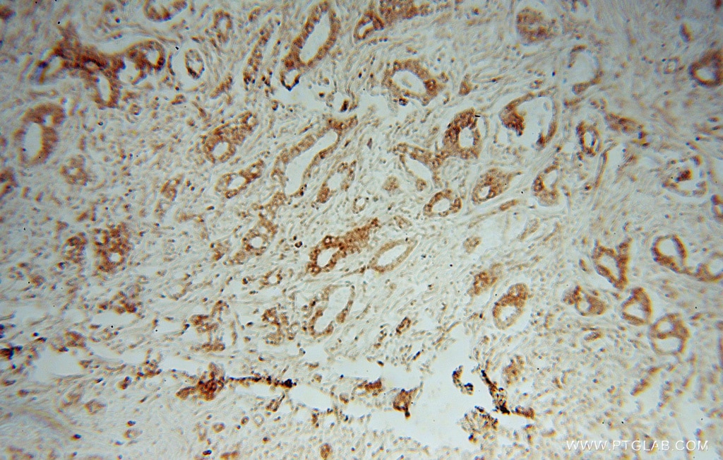 Immunohistochemistry (IHC) staining of human breast cancer tissue using TXNDC4 Polyclonal antibody (16016-1-AP)