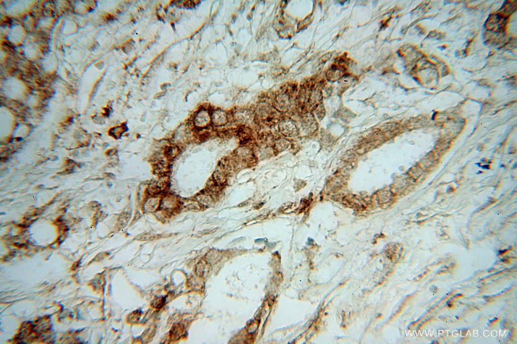 Immunohistochemistry (IHC) staining of human breast cancer tissue using TXNDC4 Polyclonal antibody (16016-1-AP)