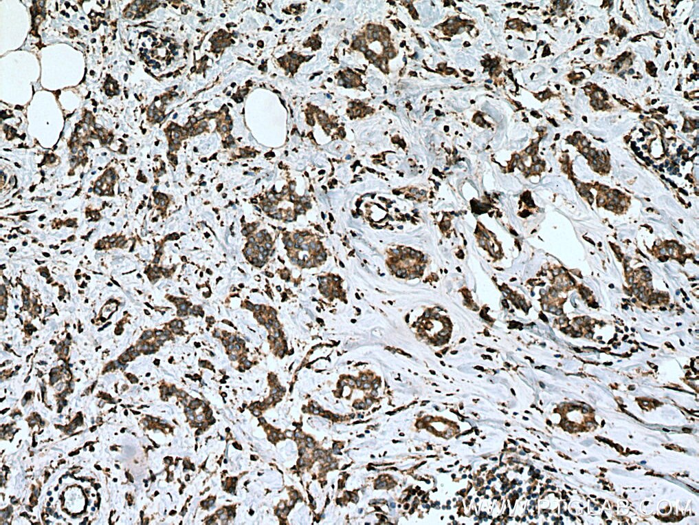 IHC staining of human breast cancer using 67426-1-Ig