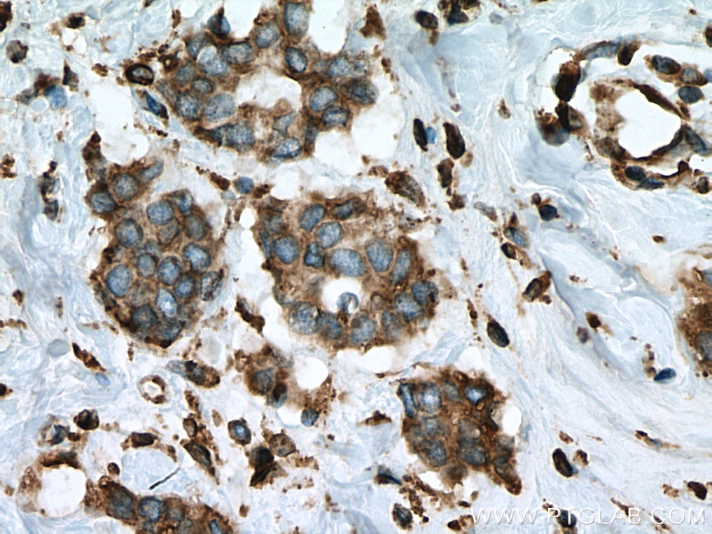 Immunohistochemistry (IHC) staining of human breast cancer tissue using ERP44 Monoclonal antibody (67426-1-Ig)