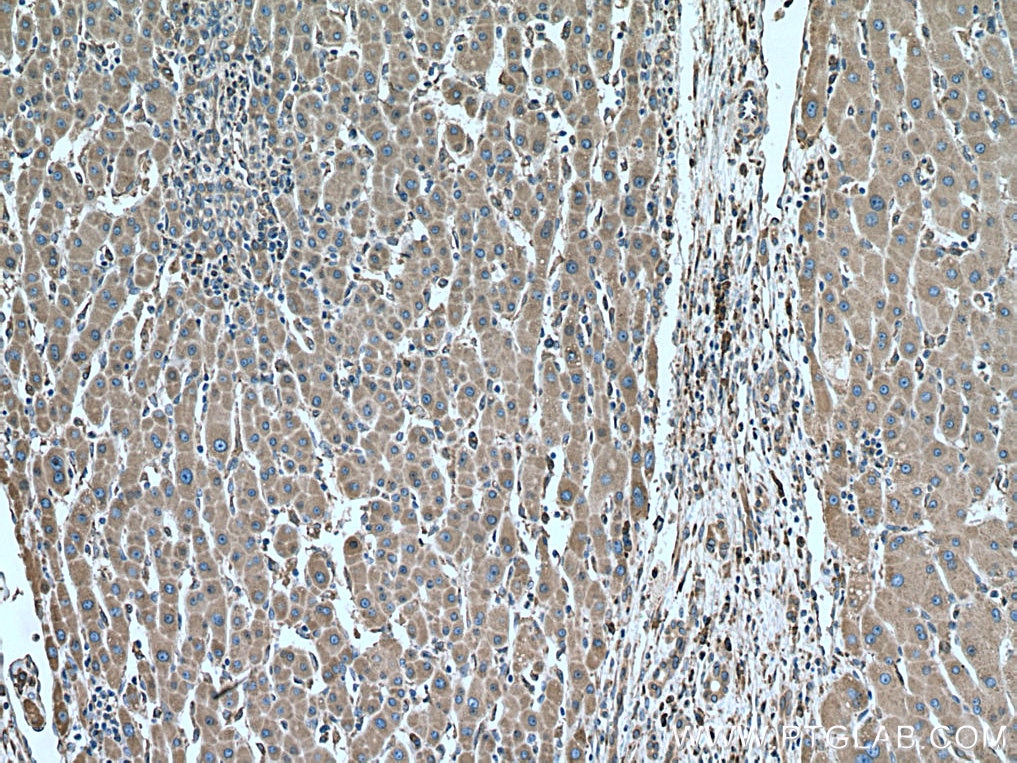 Immunohistochemistry (IHC) staining of human liver cancer tissue using ERP44 Monoclonal antibody (67426-1-Ig)