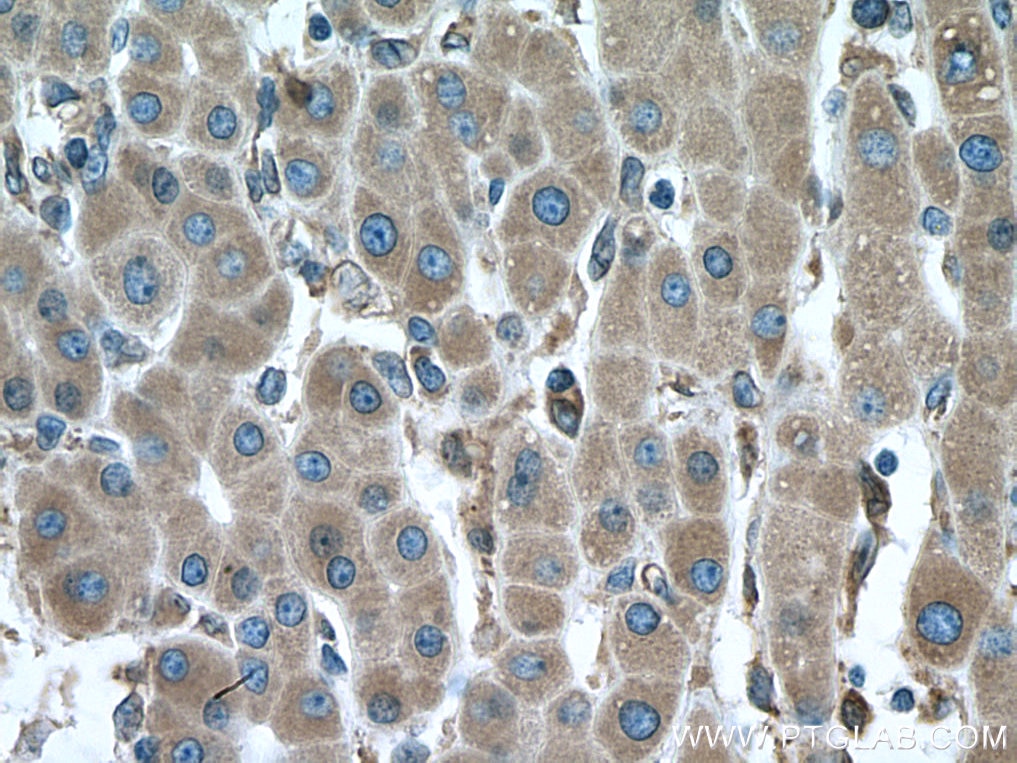 Immunohistochemistry (IHC) staining of human liver cancer tissue using ERP44 Monoclonal antibody (67426-1-Ig)