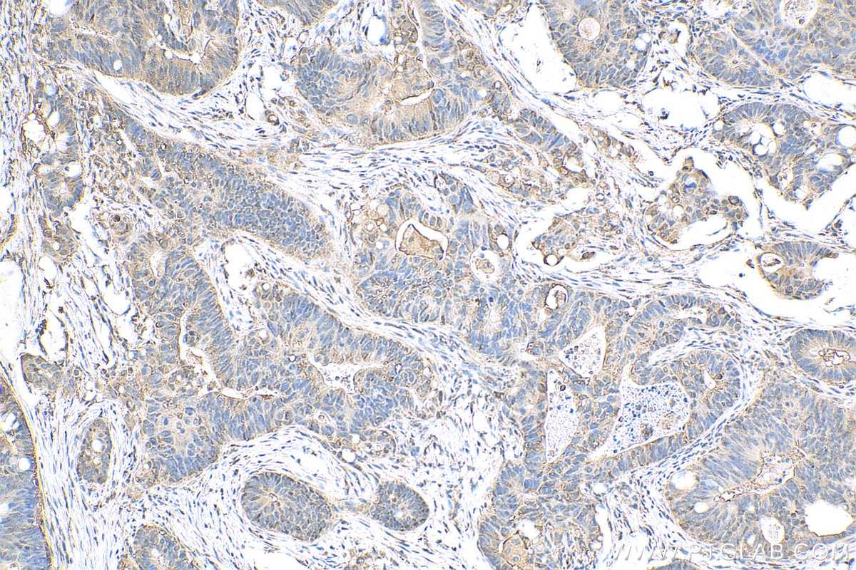 Immunohistochemistry (IHC) staining of human colon cancer tissue using MIG6; ERRFI1 Polyclonal antibody (11630-1-AP)