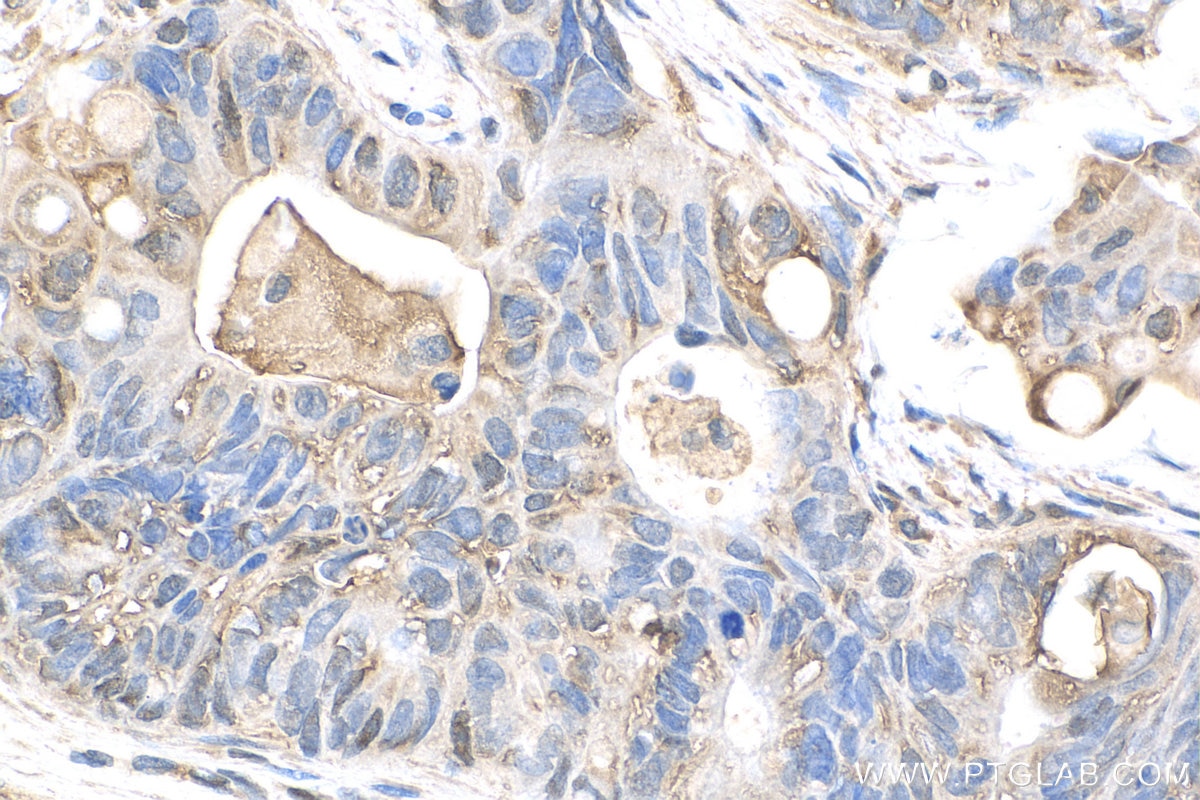 Immunohistochemistry (IHC) staining of human colon cancer tissue using MIG6; ERRFI1 Polyclonal antibody (11630-1-AP)