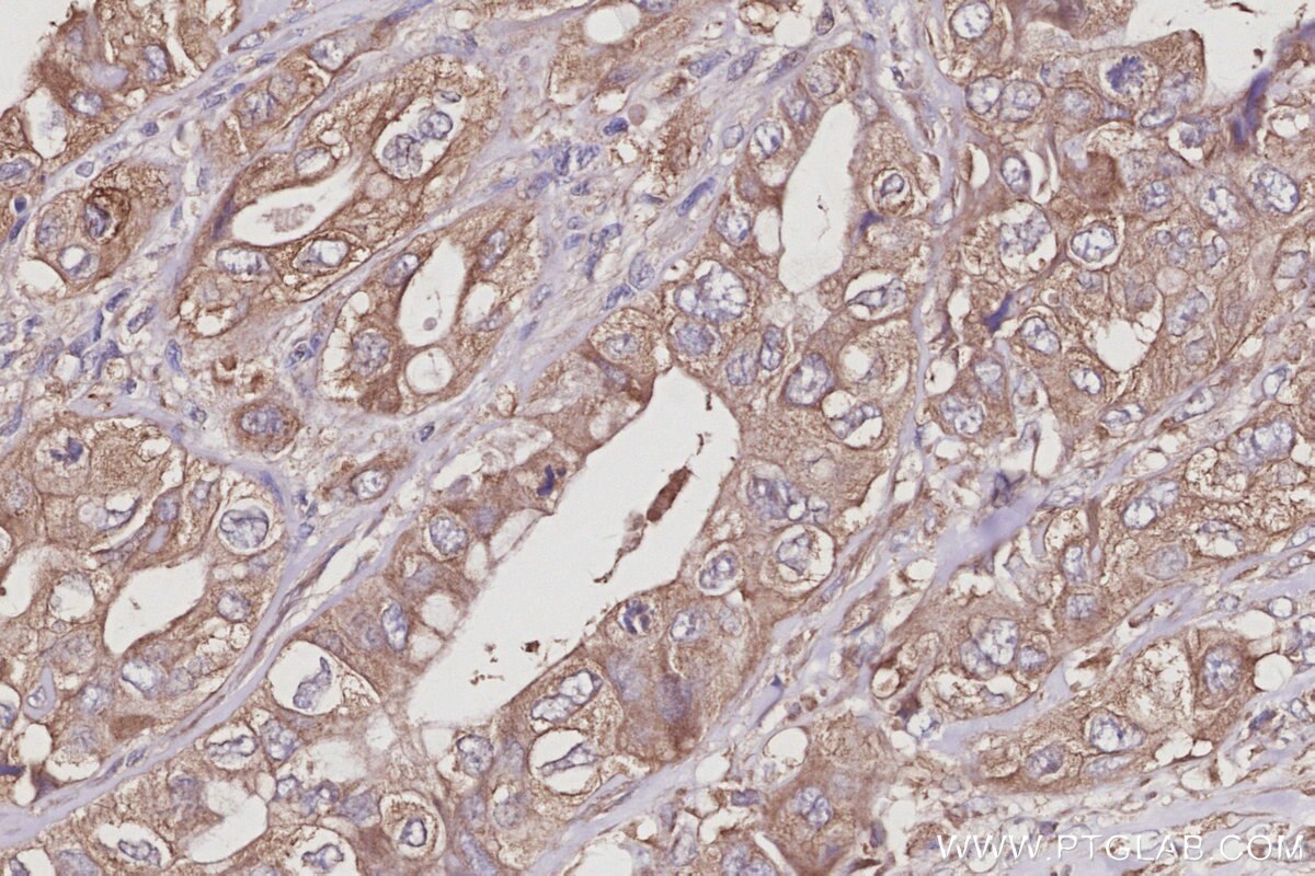 Immunohistochemistry (IHC) staining of human pancreas cancer tissue using MIG6; ERRFI1 Polyclonal antibody (11630-1-AP)