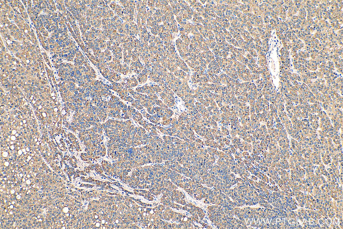 Immunohistochemistry (IHC) staining of human liver cancer tissue using ERp72 Monoclonal antibody (66365-1-Ig)