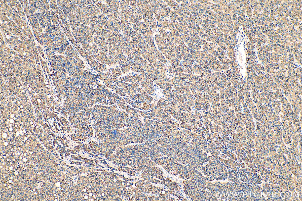 IHC staining of human liver cancer using 66365-1-Ig