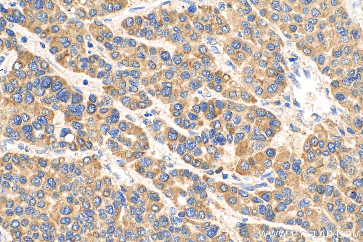 Immunohistochemistry (IHC) staining of human liver cancer tissue using ERp72 Monoclonal antibody (66365-1-Ig)