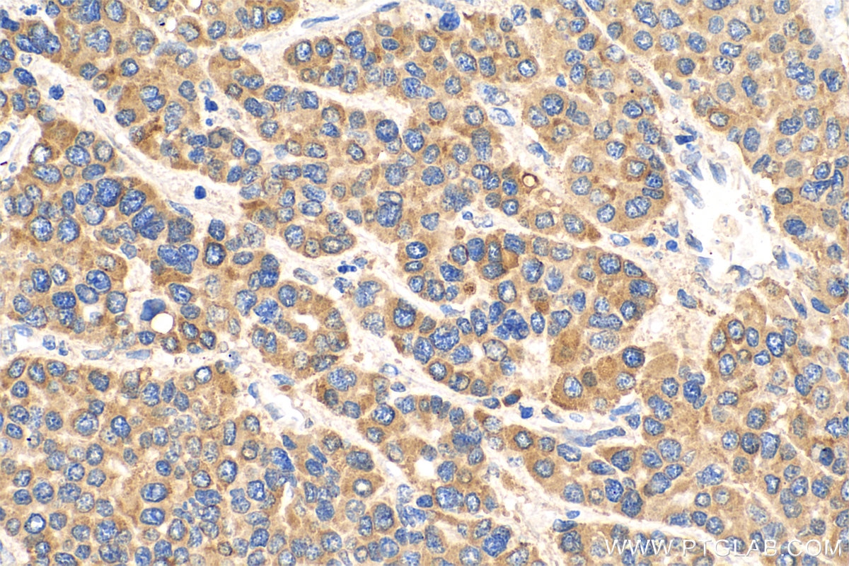 IHC staining of human liver cancer using 66365-1-Ig