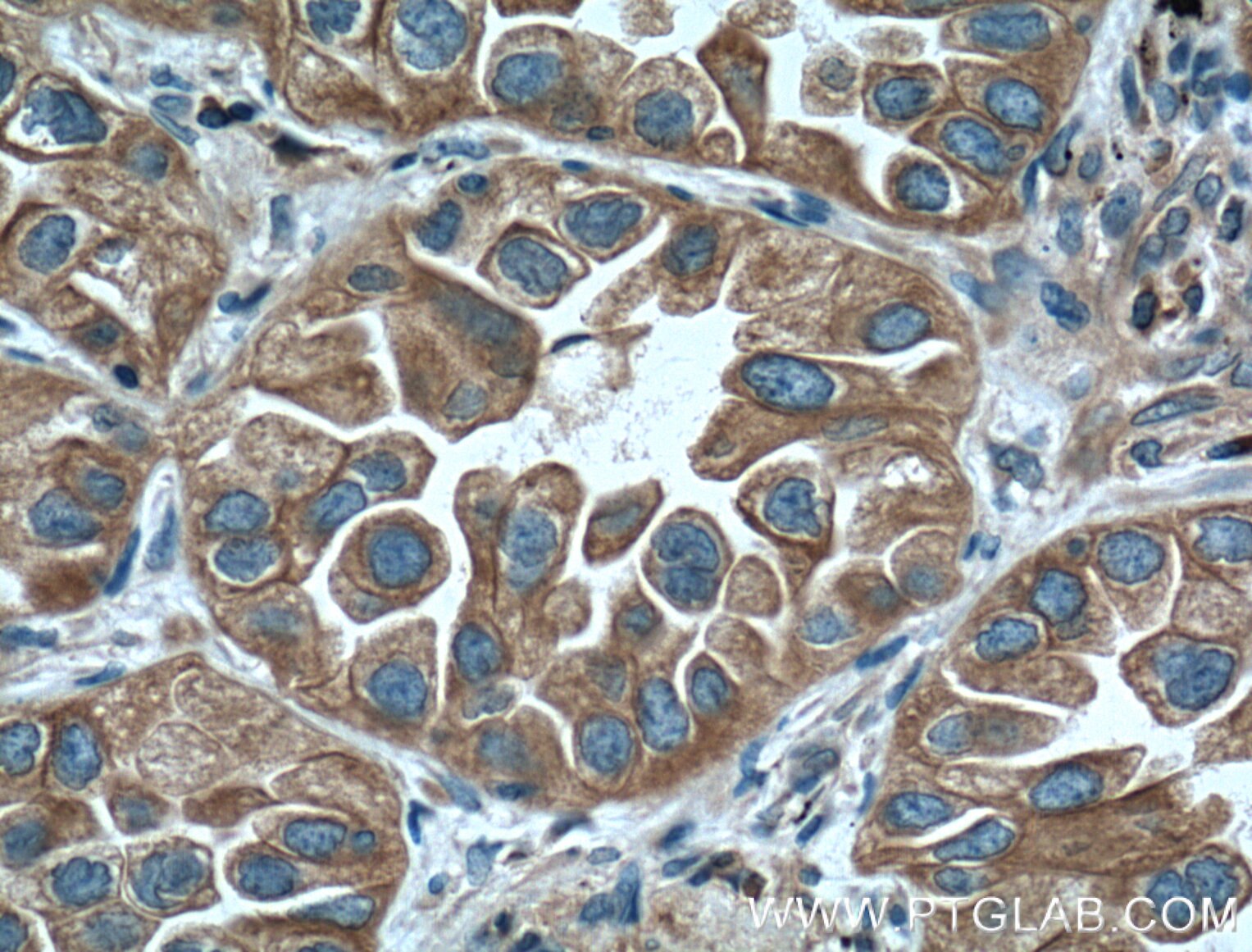 IHC staining of human lung cancer using 66365-1-Ig