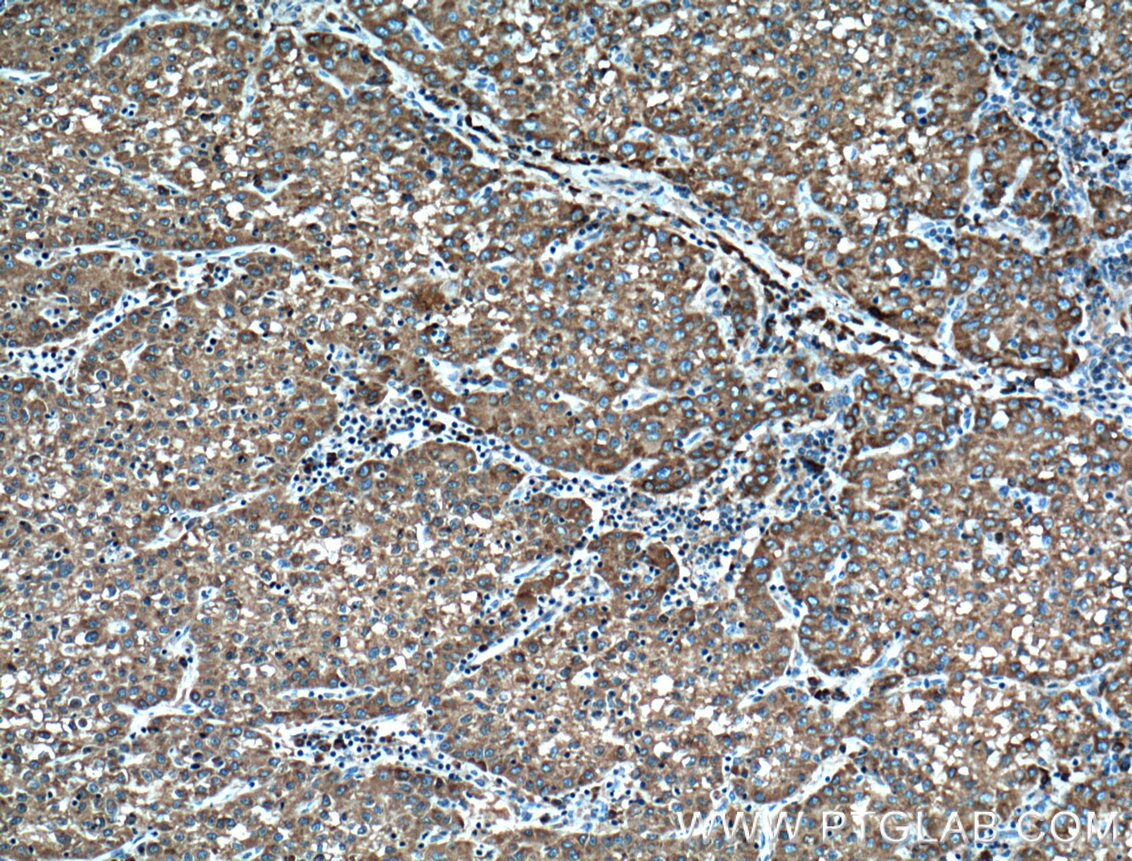IHC staining of human liver cancer using 66365-1-Ig
