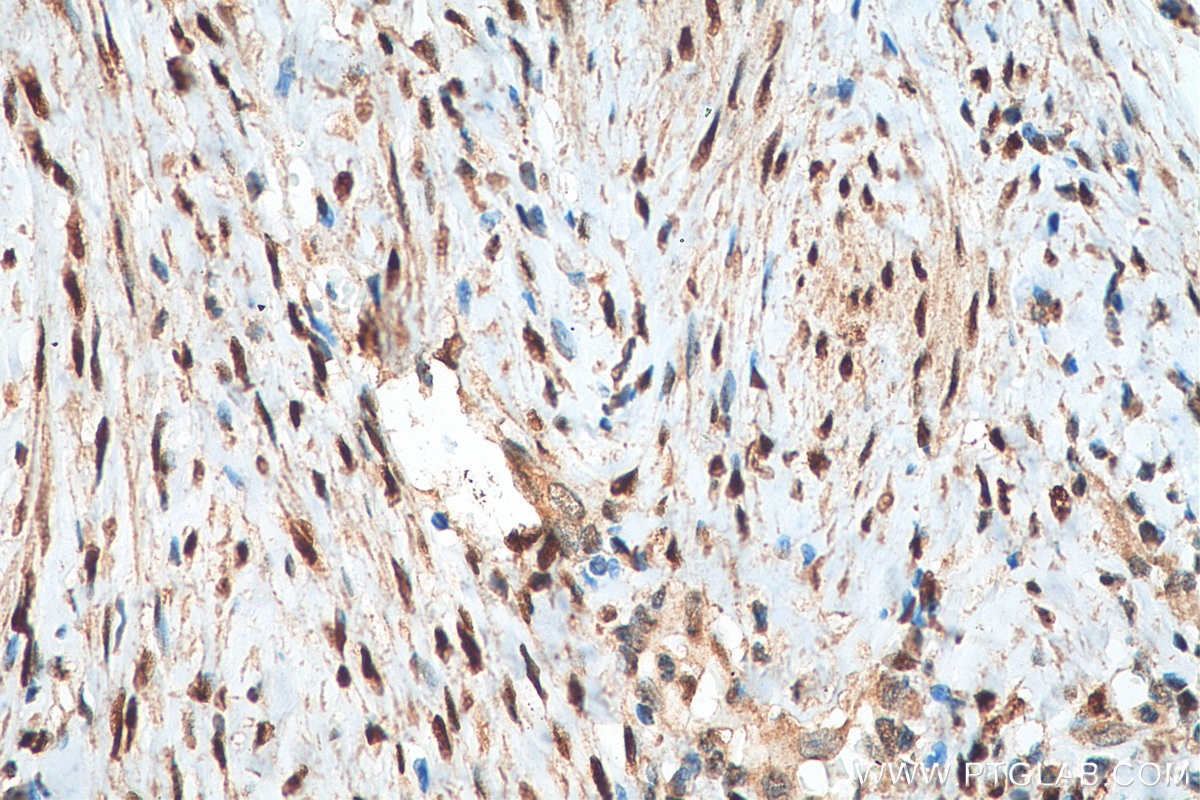 IHC staining of human cervical cancer using 21244-1-AP