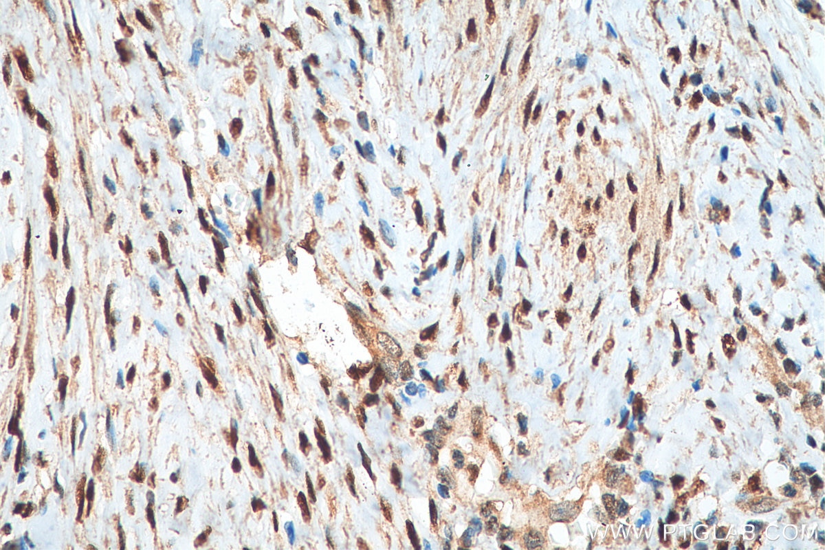 Immunohistochemistry (IHC) staining of human cervical cancer tissue using ER Polyclonal antibody (21244-1-AP)