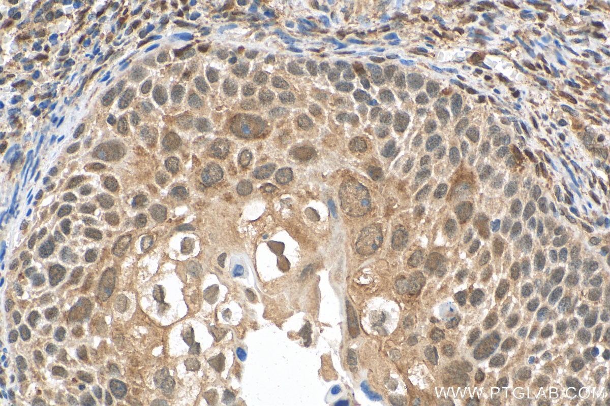 Immunohistochemistry (IHC) staining of human cervical cancer tissue using ER Polyclonal antibody (21244-1-AP)