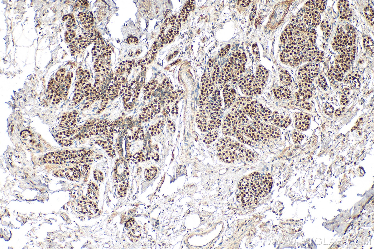 Immunohistochemistry (IHC) staining of human breast cancer tissue using ER Polyclonal antibody (21244-1-AP)