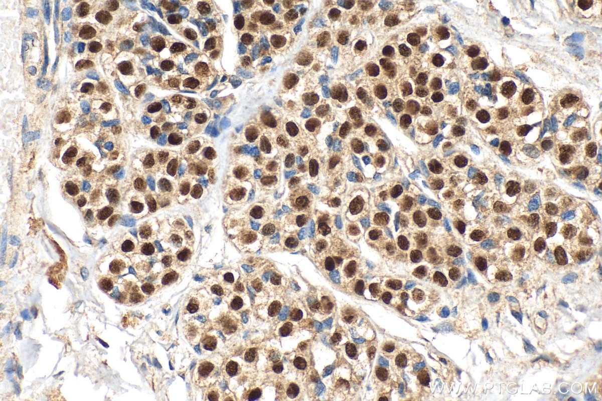 Immunohistochemistry (IHC) staining of human breast cancer tissue using ER Polyclonal antibody (21244-1-AP)
