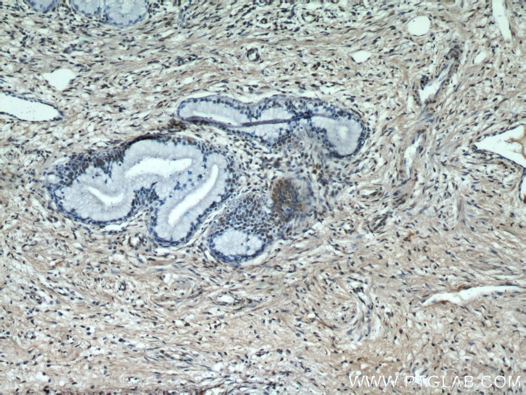 Immunohistochemistry (IHC) staining of human cervix tissue using ESR2 Beta 3 Polyclonal antibody (55441-1-AP)