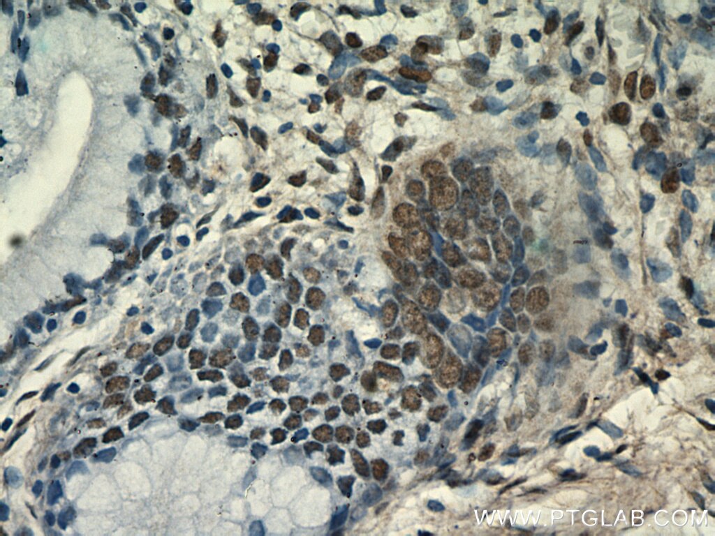 Immunohistochemistry (IHC) staining of human cervix tissue using ESR2 Beta 3 Polyclonal antibody (55441-1-AP)