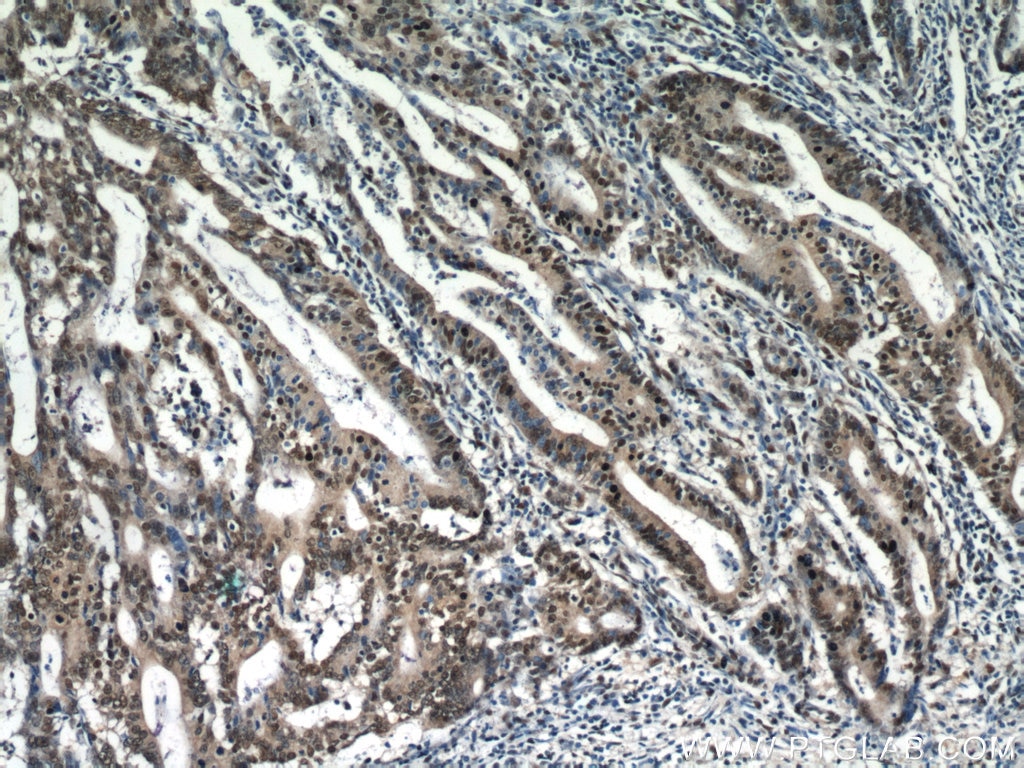 Immunohistochemistry (IHC) staining of human endometrial cancer tissue using ESR2 Beta 3 Polyclonal antibody (55441-1-AP)