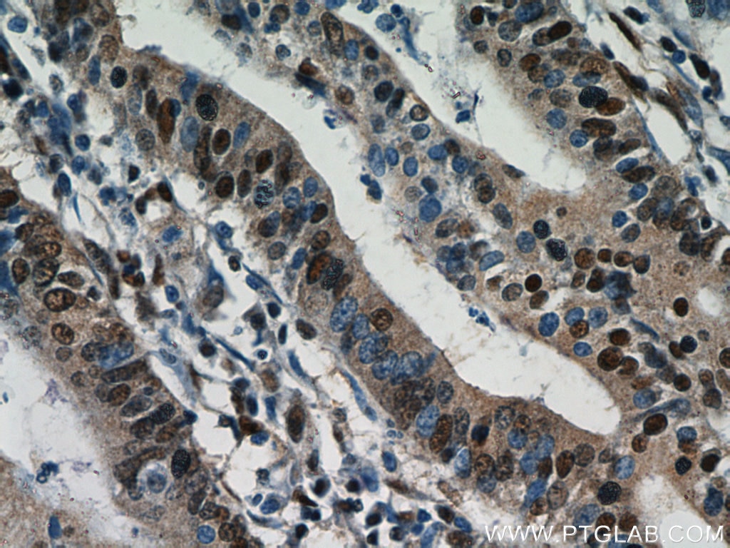 Immunohistochemistry (IHC) staining of human endometrial cancer tissue using ESR2 Beta 3 Polyclonal antibody (55441-1-AP)