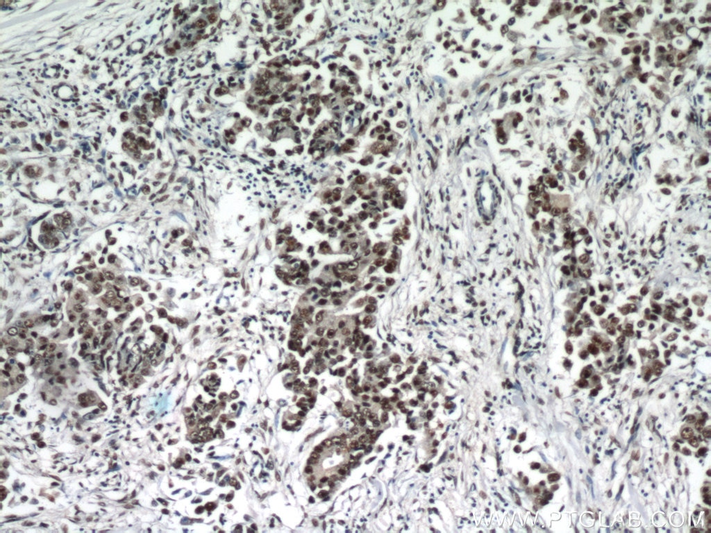 Immunohistochemistry (IHC) staining of human breast cancer tissue using ESR2 Beta 3 Polyclonal antibody (55441-1-AP)