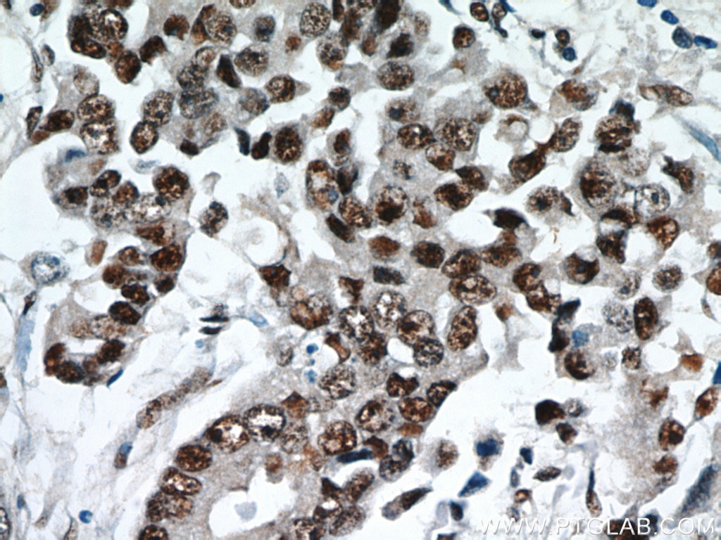 Immunohistochemistry (IHC) staining of human breast cancer tissue using ESR2 Beta 3 Polyclonal antibody (55441-1-AP)