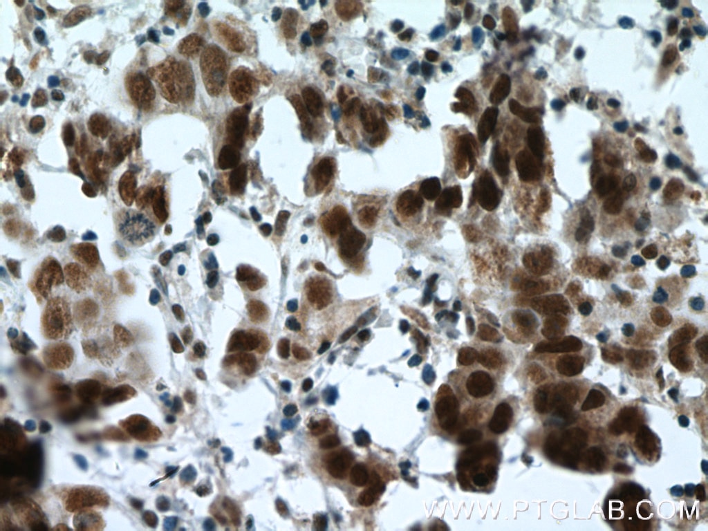 Immunohistochemistry (IHC) staining of human prostate cancer tissue using ESR2 Beta 6 Polyclonal antibody (55471-1-AP)