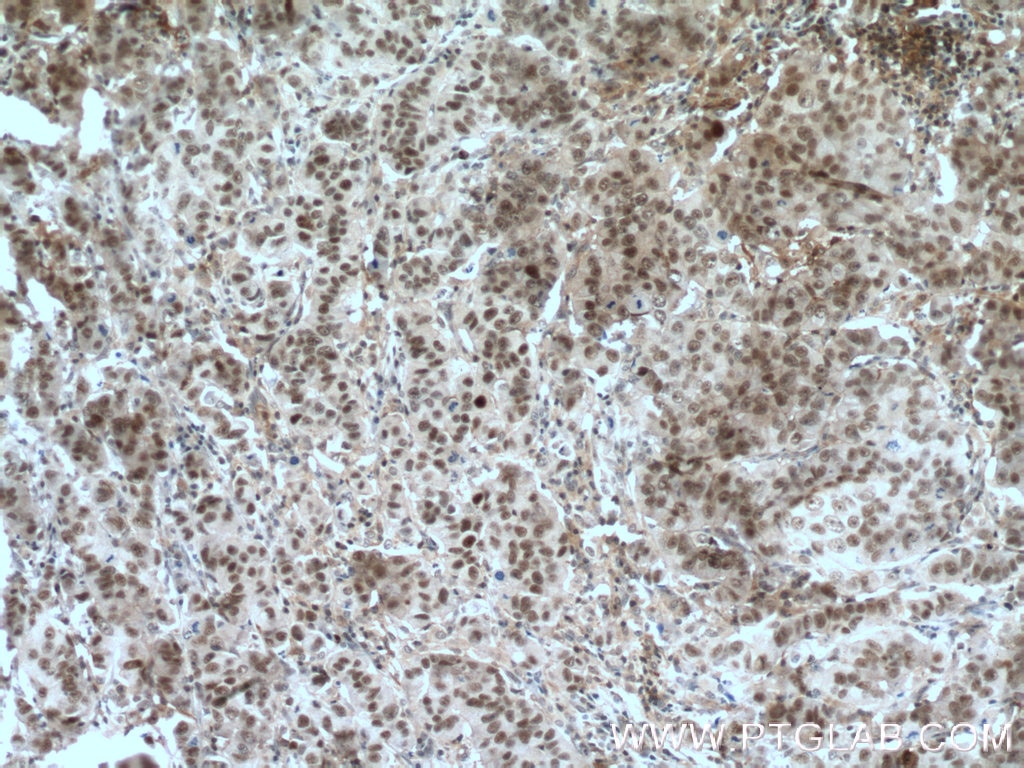 Immunohistochemistry (IHC) staining of human prostate cancer tissue using ESR2 Beta 6 Polyclonal antibody (55471-1-AP)