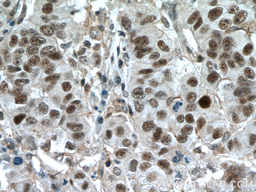 Immunohistochemistry (IHC) staining of human prostate cancer tissue using ESR2 Beta 6 Polyclonal antibody (55471-1-AP)