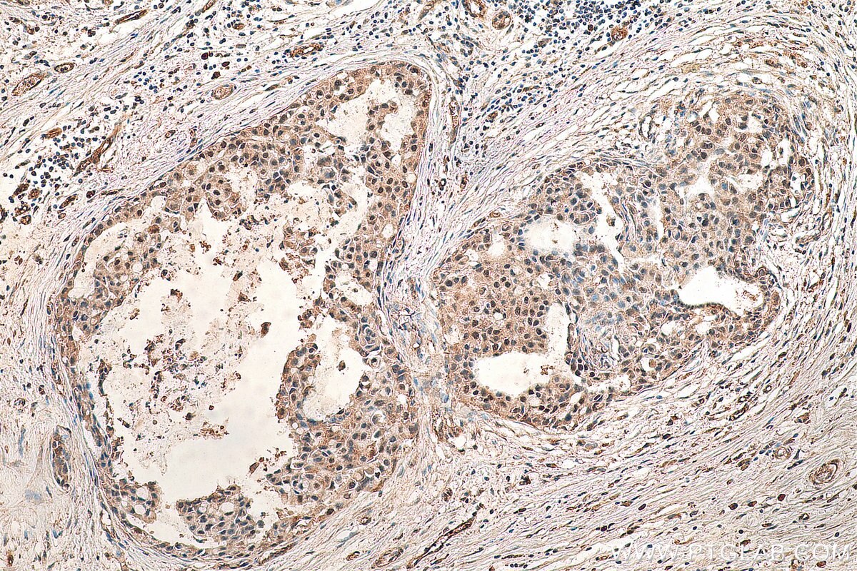 Immunohistochemistry (IHC) staining of human breast cancer tissue using ESRP2 Polyclonal antibody (23117-1-AP)