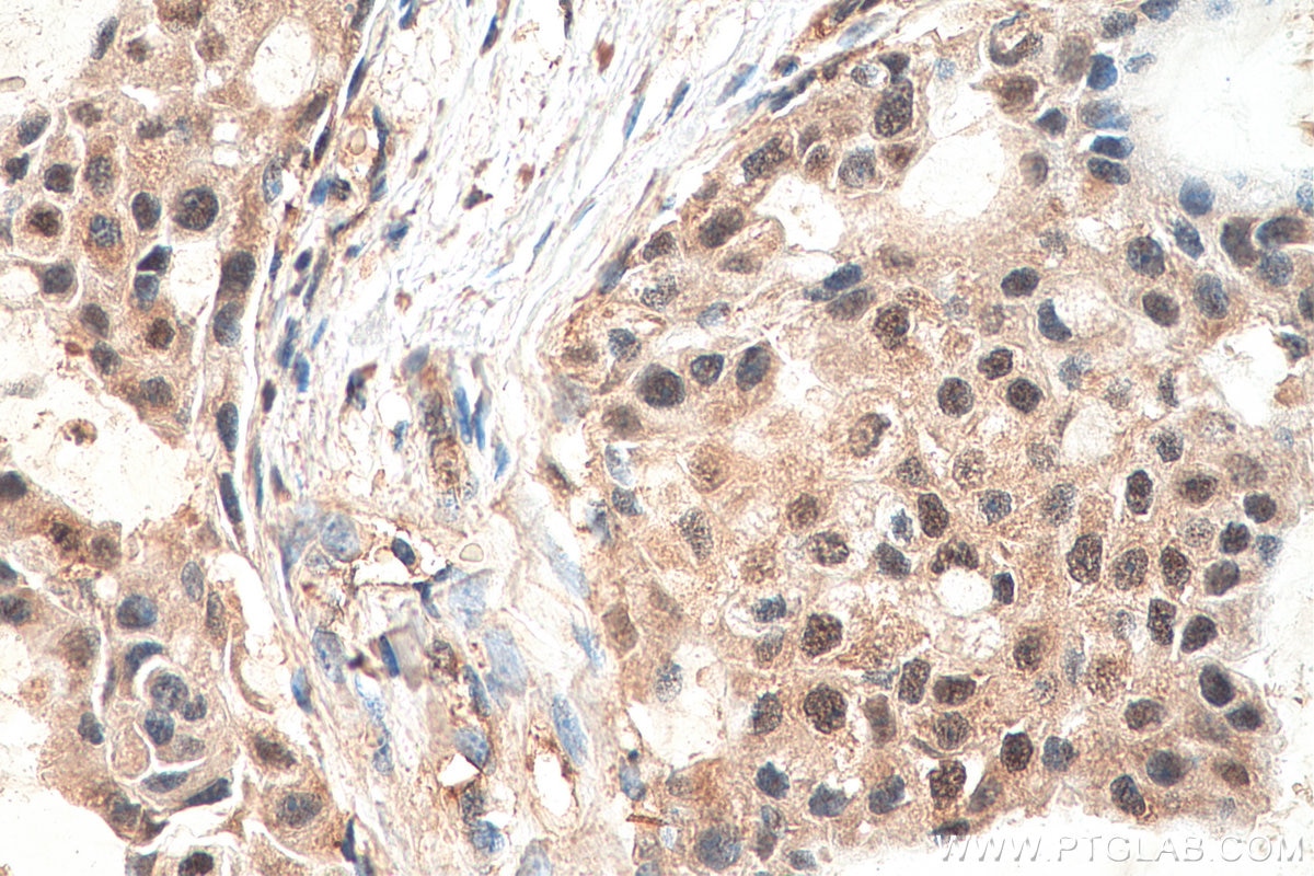Immunohistochemistry (IHC) staining of human breast cancer tissue using ESRP2 Polyclonal antibody (23117-1-AP)