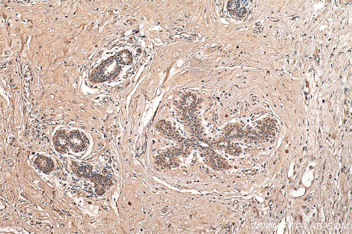 Immunohistochemistry (IHC) staining of human breast cancer tissue using ESRP2 Polyclonal antibody (23117-1-AP)