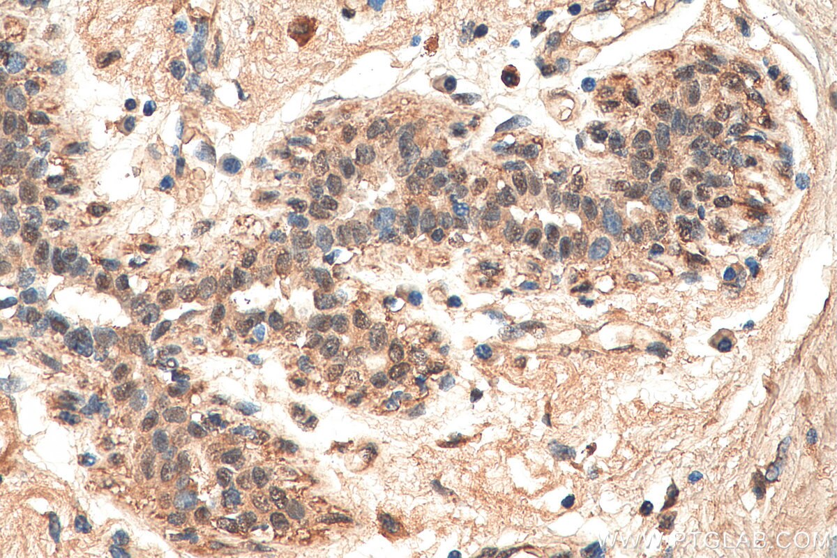 Immunohistochemistry (IHC) staining of human breast cancer tissue using ESRP2 Polyclonal antibody (23117-1-AP)