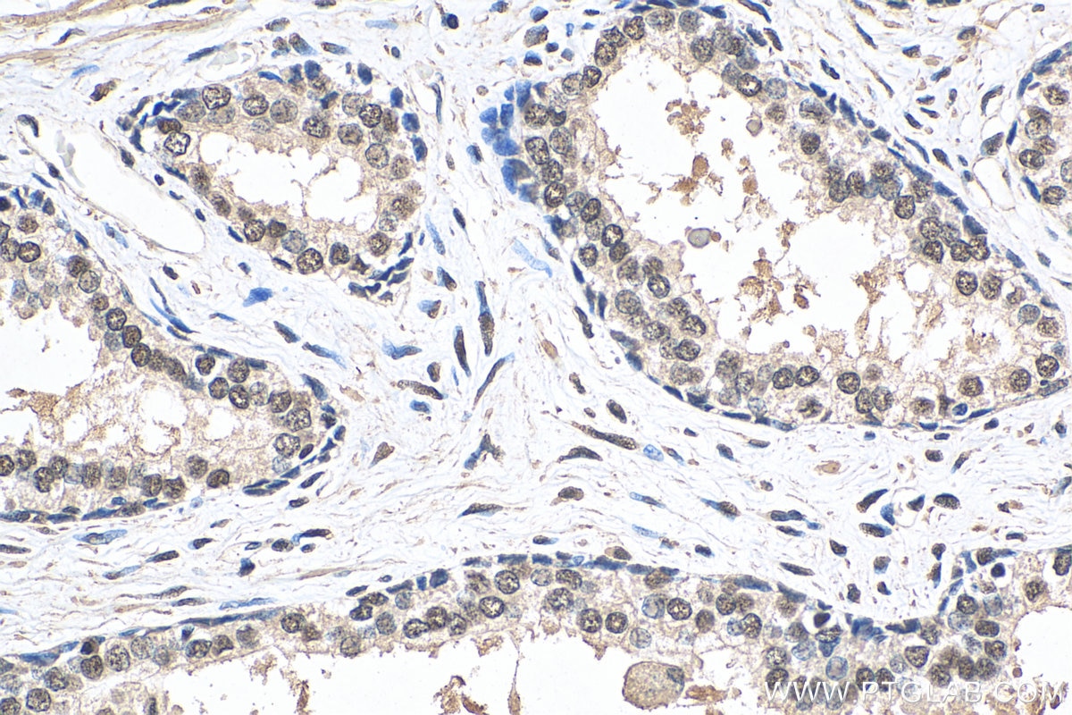 Immunohistochemistry (IHC) staining of human prostate cancer tissue using ESRRB Monoclonal antibody (66818-1-Ig)