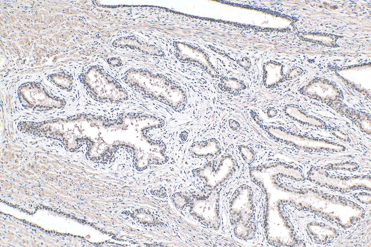 Immunohistochemistry (IHC) staining of human prostate cancer tissue using ESRRB Monoclonal antibody (66818-1-Ig)