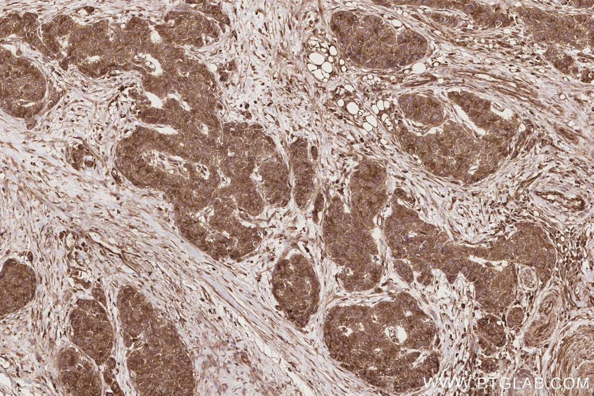 IHC staining of human stomach cancer using 67688-1-Ig Immunohistochemistry (IHC) staining of human stomach cancer tissue using ESYT1 Monoclonal antibody (67688-1-Ig)