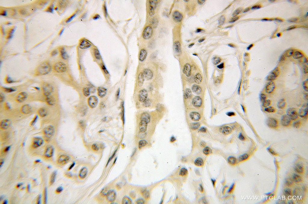 Immunohistochemistry (IHC) staining of human pancreas cancer tissue using ETF1 Polyclonal antibody (10884-1-AP)