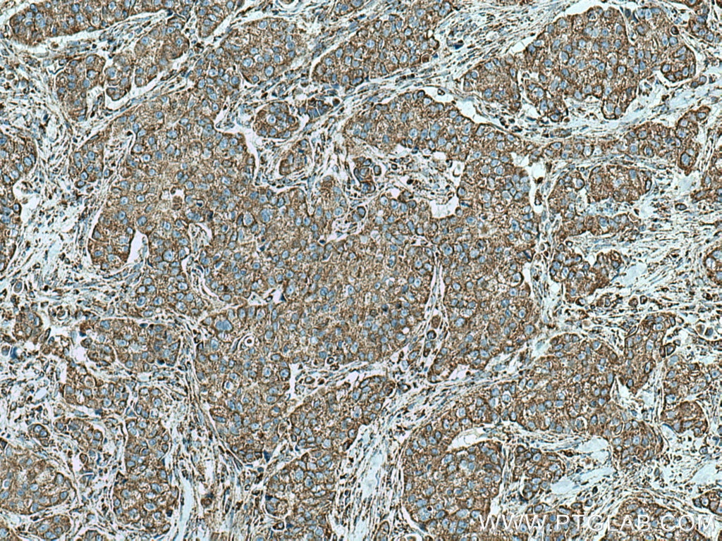 Immunohistochemistry (IHC) staining of human breast cancer tissue using ETFA Polyclonal antibody (12262-1-AP)