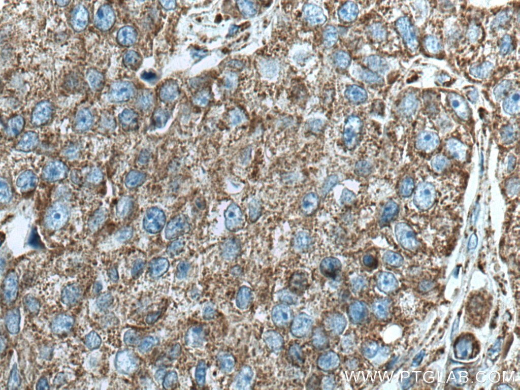 Immunohistochemistry (IHC) staining of human breast cancer tissue using ETFA Polyclonal antibody (12262-1-AP)