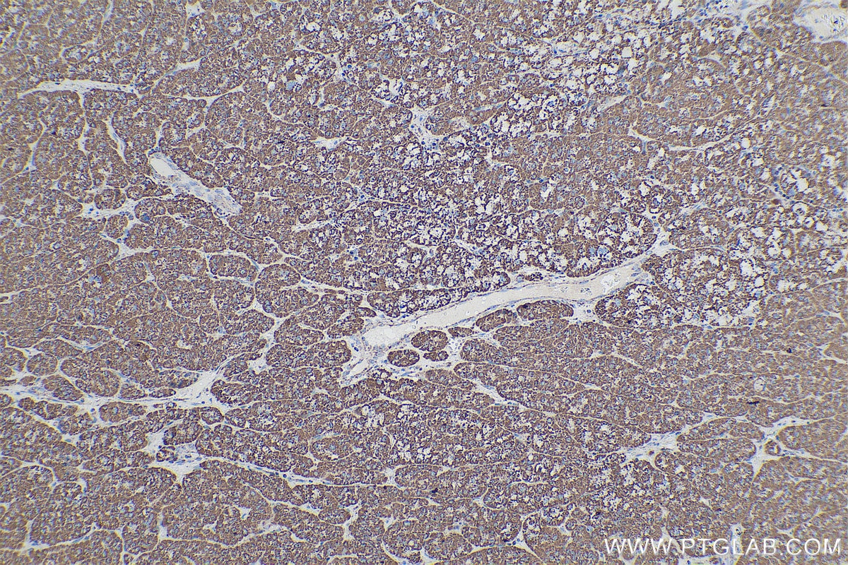 Immunohistochemistry (IHC) staining of human liver cancer tissue using ETFA Monoclonal antibody (67661-1-Ig)